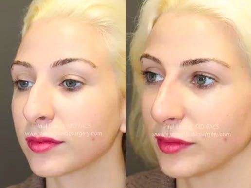 Dermal Fillers Before & After Gallery - Patient 4890584 - Image 3