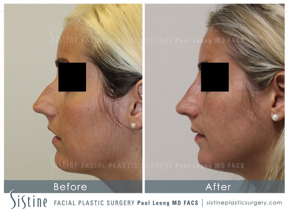 Dermal Fillers Before & After Gallery - Patient 4890589 - Image 1