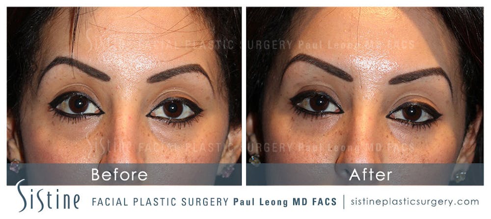 Dermal Fillers Before & After Gallery - Patient 4890623 - Image 1