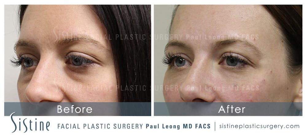 Dermal Fillers Before & After Gallery - Patient 4890893 - Image 2