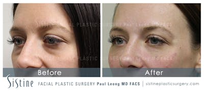 Dermal Fillers Before & After Gallery - Patient 4890893 - Image 2