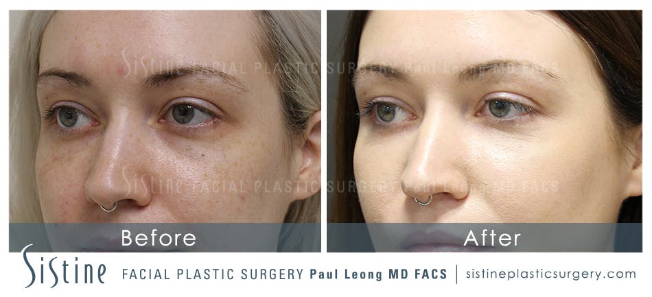 Dermal Fillers Before & After Gallery - Patient 4890896 - Image 1
