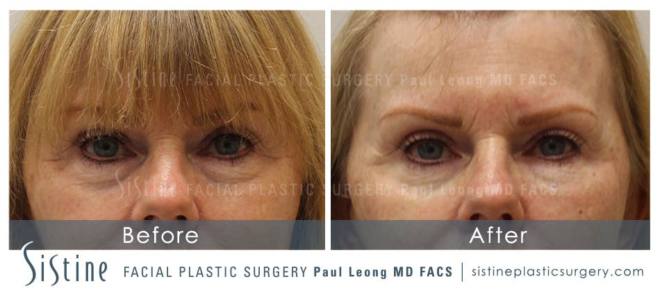 Dermal Fillers Before & After Gallery - Patient 4890898 - Image 1