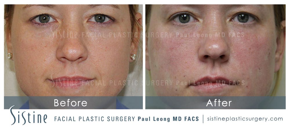 Dermal Fillers Before & After Gallery - Patient 4890899 - Image 2