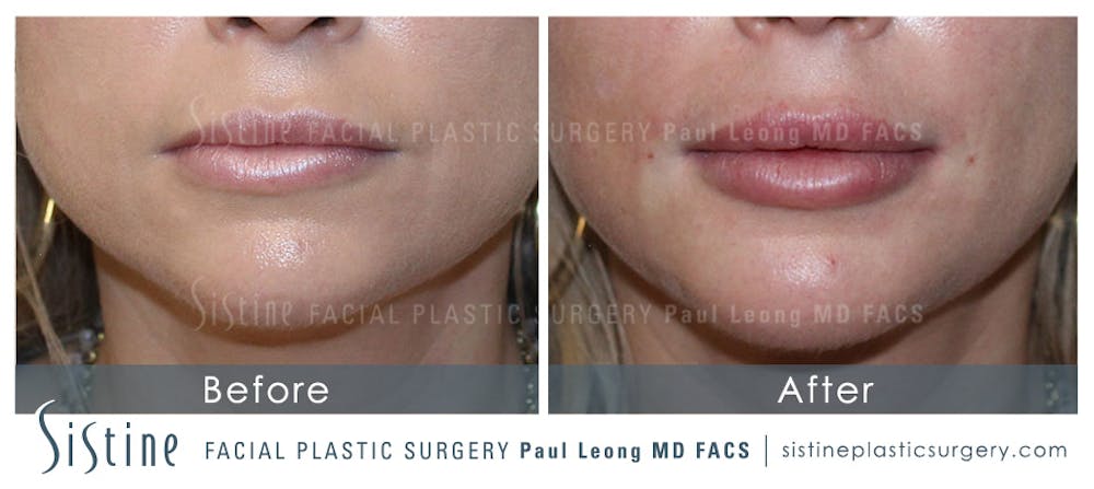 Dermal Fillers Before & After Gallery - Patient 4890900 - Image 1