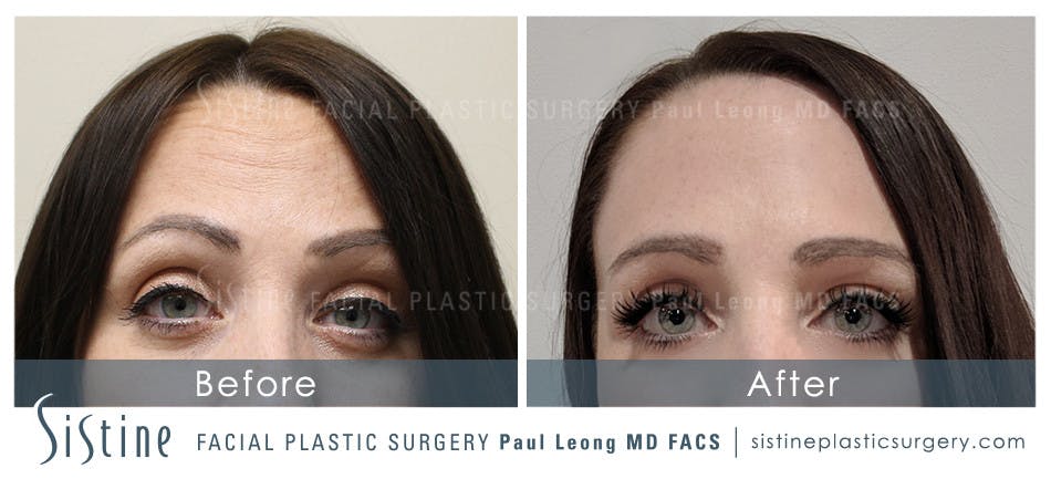 Botox® Cosmetic/ Dysport Before & After Gallery - Patient 4890991 - Image 1