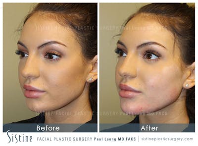Chin Augmentation Before & After Gallery - Patient 4891011 - Image 1