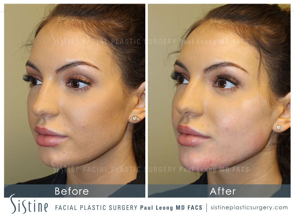 Chin Augmentation Before & After Gallery - Patient 4891011 - Image 1