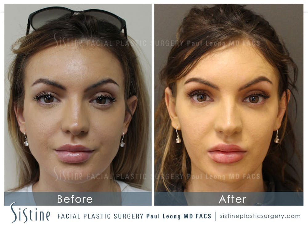 Jawline Slimming Before & After Gallery - Patient 4891014 - Image 1