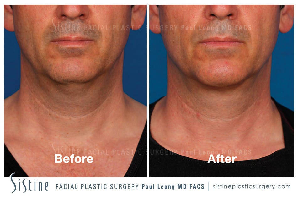 Kybella Before & After Gallery - Patient 4891024 - Image 1