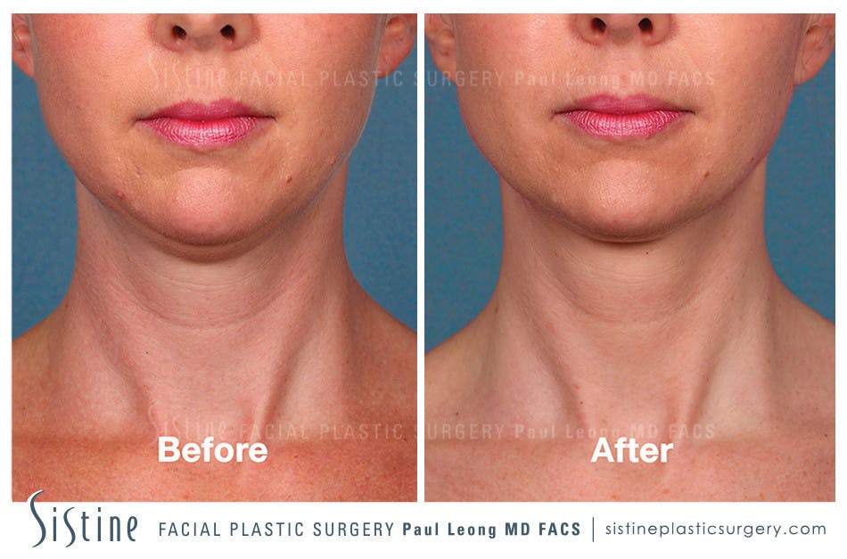 Kybella Before & After Gallery - Patient 4891026 - Image 1