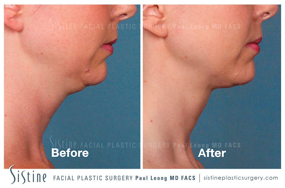 Kybella Before & After Gallery - Patient 4891027 - Image 1