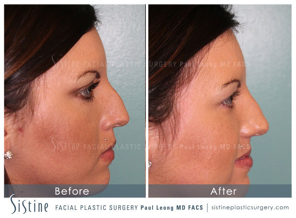 Non-Surgical Rhinoplasty Before & After Gallery - Patient 4891045 - Image 1