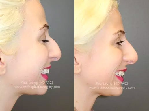 Non-Surgical Rhinoplasty Before & After Gallery - Patient 4891050 - Image 1