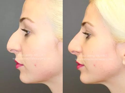 Non-Surgical Rhinoplasty Before & After Gallery - Patient 4891050 - Image 2