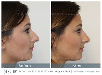 Non-Surgical Rhinoplasty Before & After Gallery - Patient 4891057 - Image 1