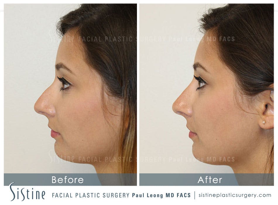 Non-Surgical Rhinoplasty Before & After Gallery - Patient 4891057 - Image 2
