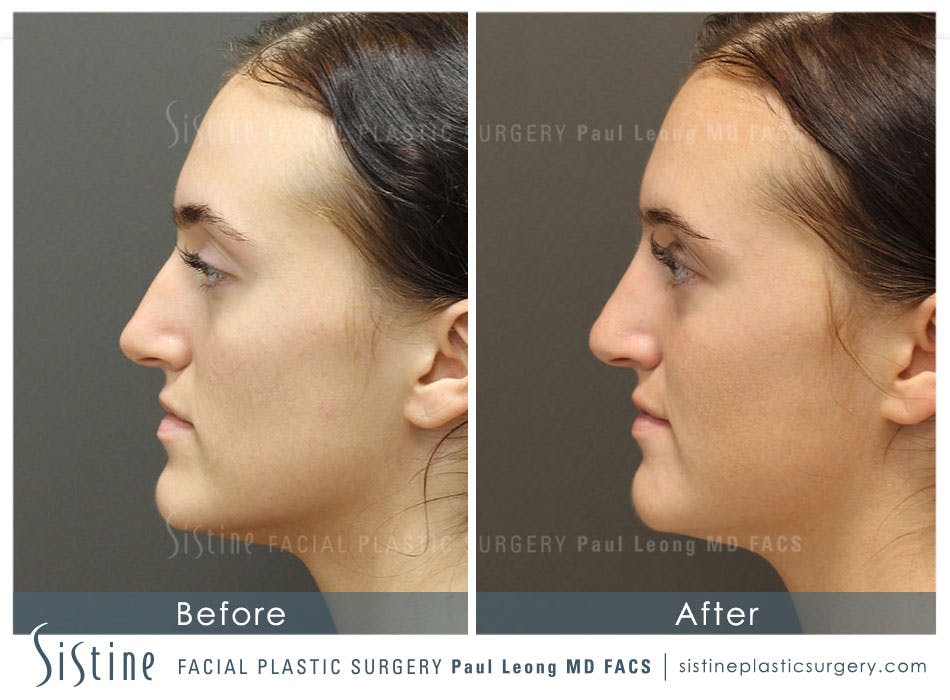 Non-Surgical Rhinoplasty Before & After Gallery - Patient 4891064 - Image 2