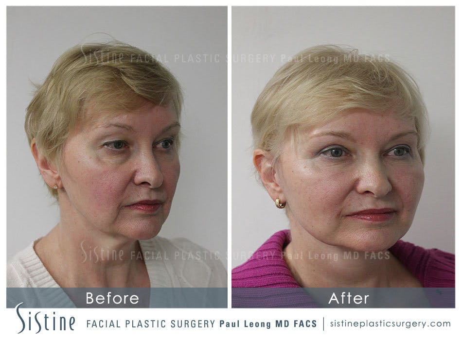 Restylane/ Juvederm Before & After Gallery - Patient 4891076 - Image 3
