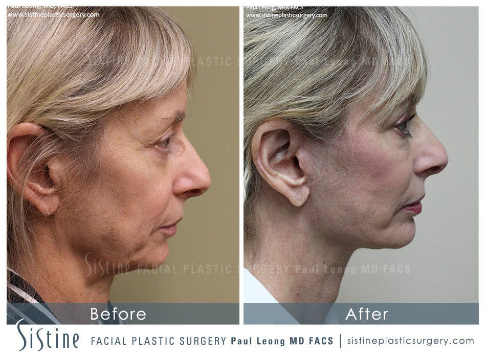 Restylane/ Juvederm Before & After Gallery - Patient 4891079 - Image 4