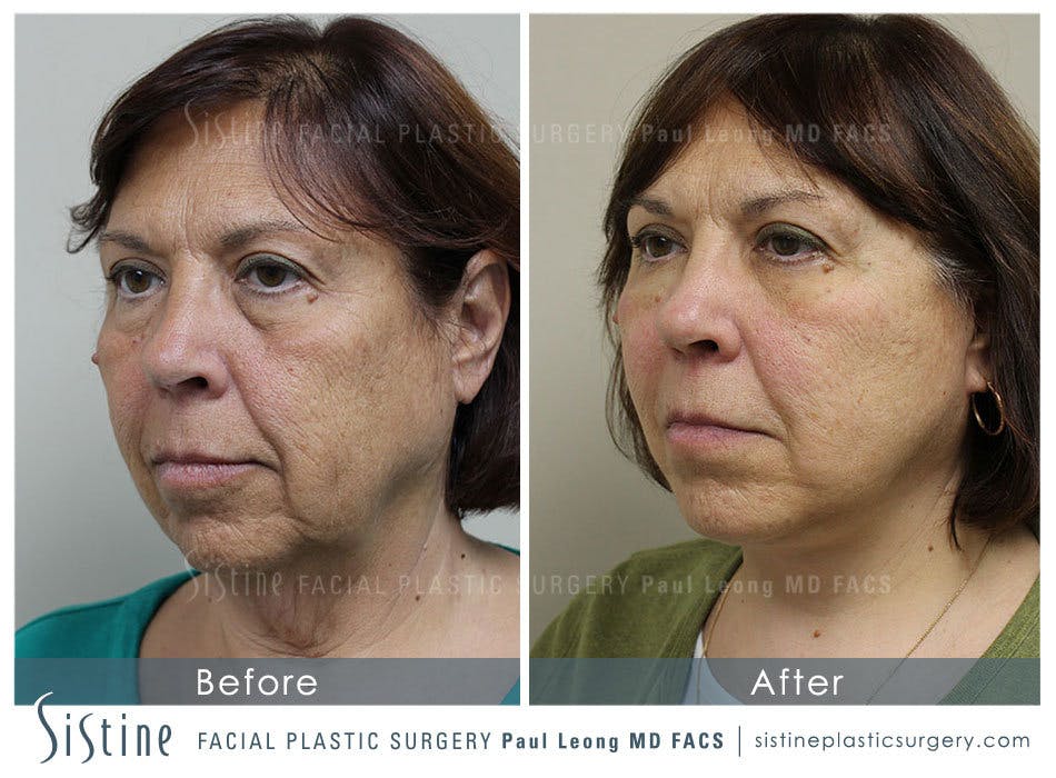 Restylane/ Juvederm Before & After Gallery - Patient 4891082 - Image 1
