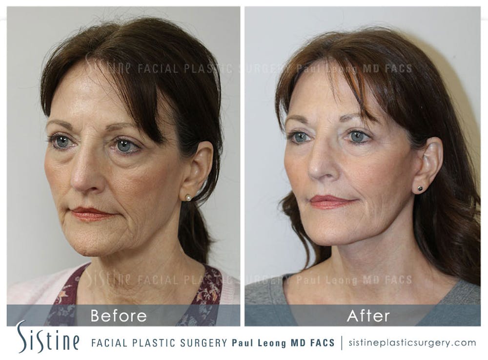 Restylane/ Juvederm Before & After Gallery - Patient 4891084 - Image 3