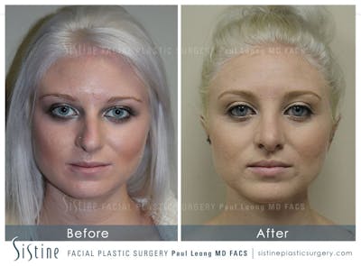 Restylane/ Juvederm Before & After Gallery - Patient 4891105 - Image 1