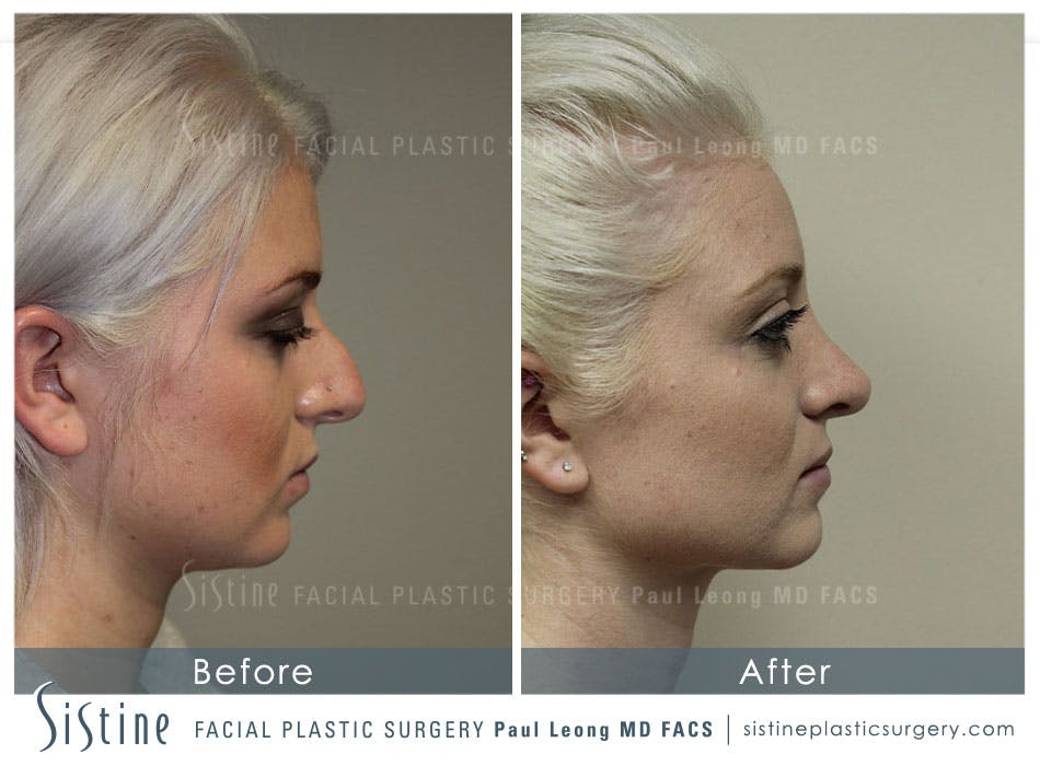 Restylane/ Juvederm Before & After Gallery - Patient 4891105 - Image 2