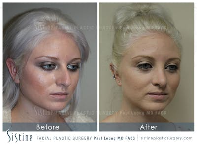 Restylane/ Juvederm Before & After Gallery - Patient 4891105 - Image 4