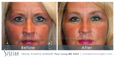 Restylane/ Juvederm Before & After Gallery - Patient 4891123 - Image 1
