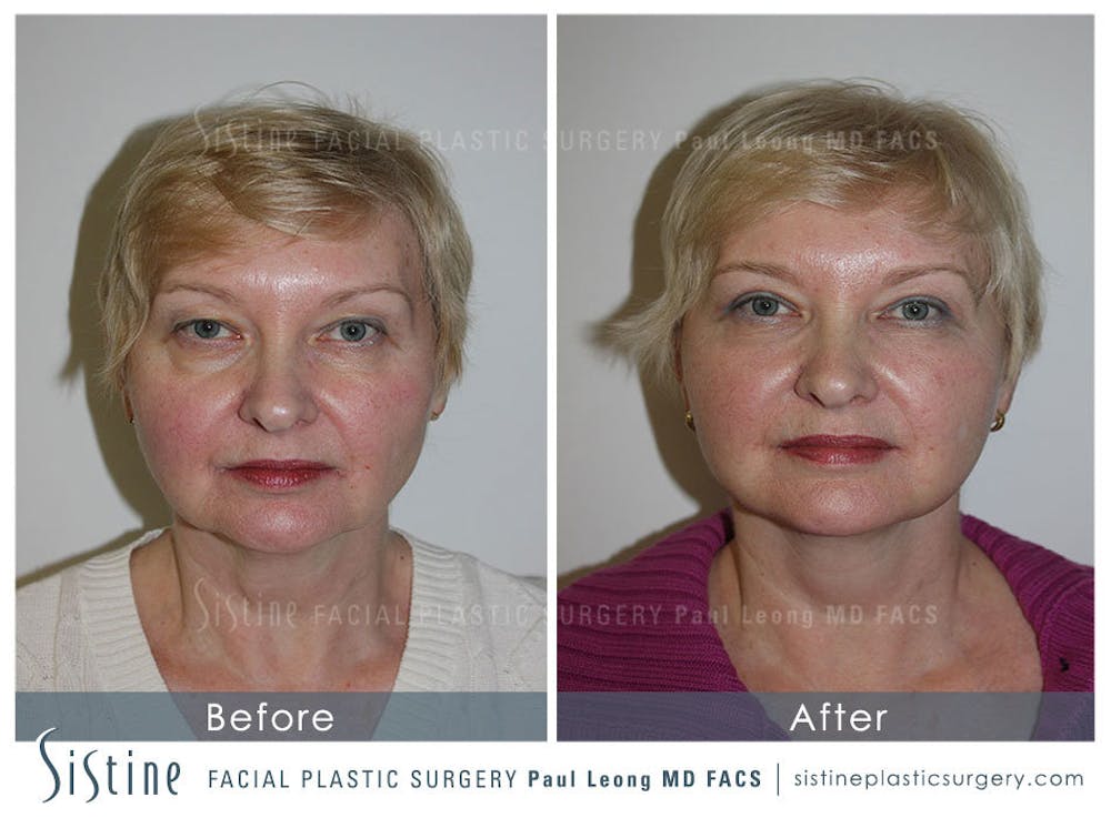 Restylane/ Juvederm Before & After Gallery - Patient 4891335 - Image 1