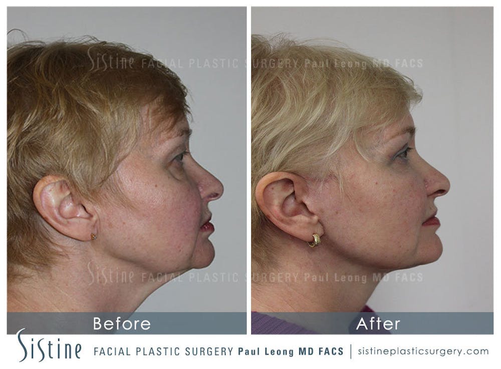 Restylane/ Juvederm Before & After Gallery - Patient 4891335 - Image 2