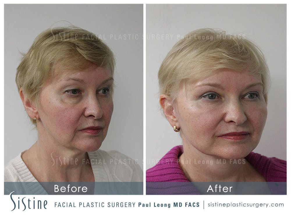 Restylane/ Juvederm Before & After Gallery - Patient 4891335 - Image 3