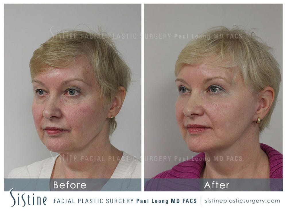 Restylane/ Juvederm Before & After Gallery - Patient 4891335 - Image 5