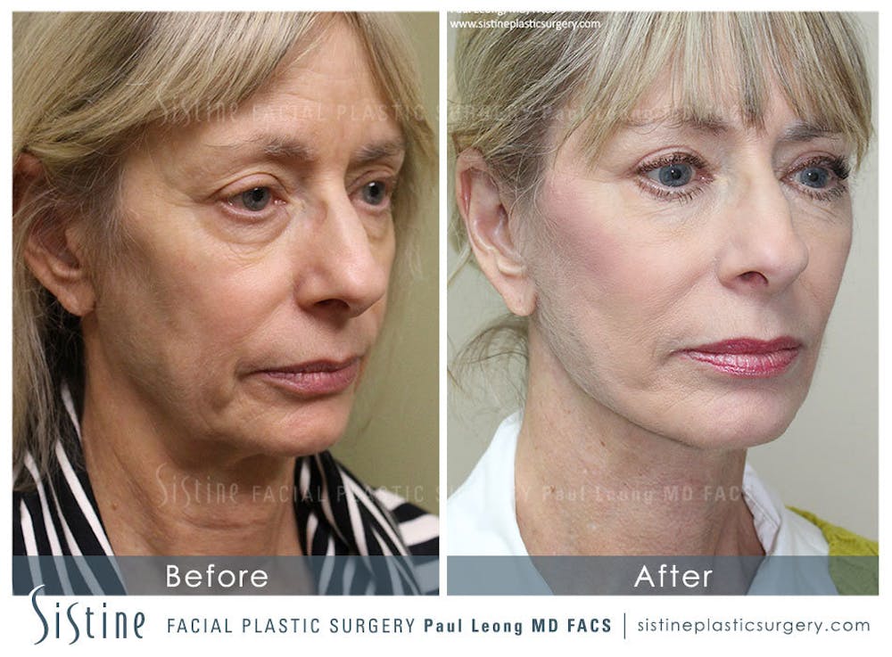 Restylane/ Juvederm Before & After Gallery - Patient 4891338 - Image 1