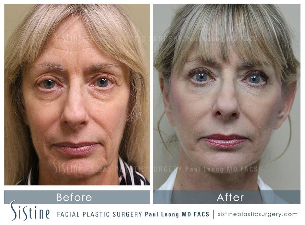Restylane/ Juvederm Before & After Gallery - Patient 4891338 - Image 3