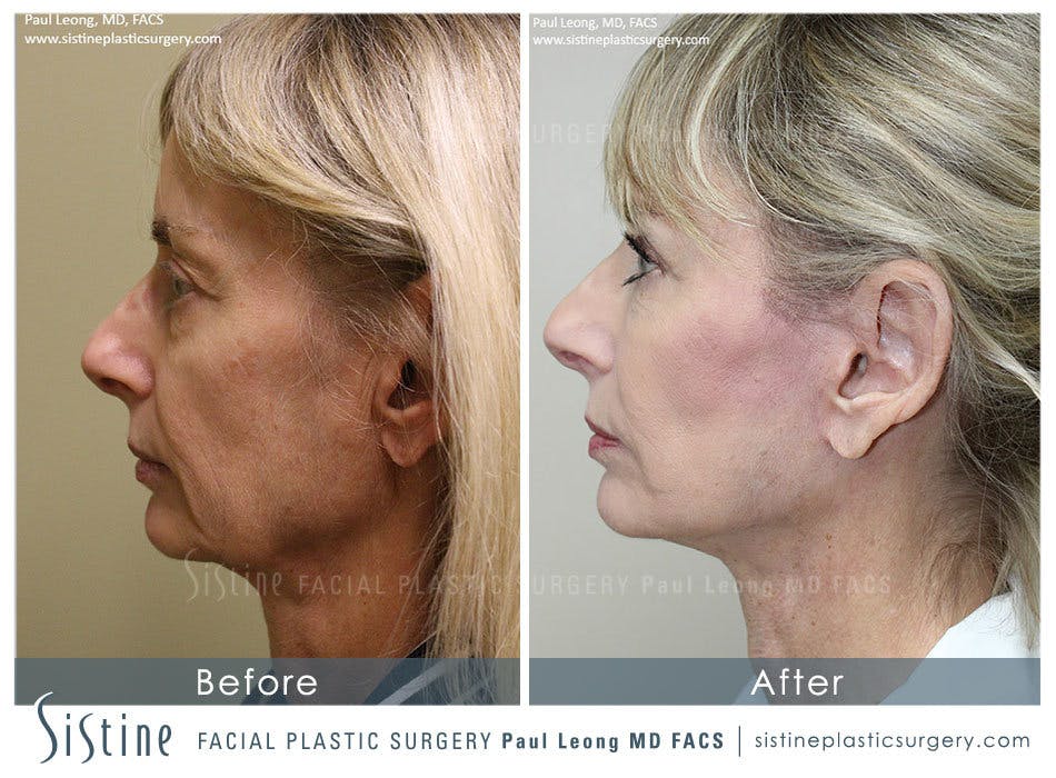 Restylane/ Juvederm Before & After Gallery - Patient 4891338 - Image 5