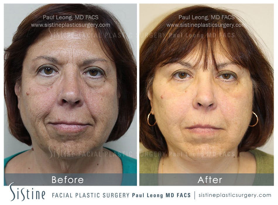 Restylane/ Juvederm Before & After Gallery - Patient 4891341 - Image 2