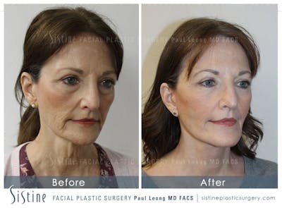 Restylane/ Juvederm Before & After Gallery - Patient 4891343 - Image 2