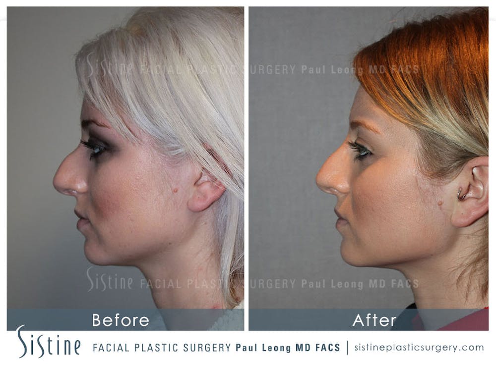 Restylane/ Juvederm Before & After Gallery - Patient 4891347 - Image 1