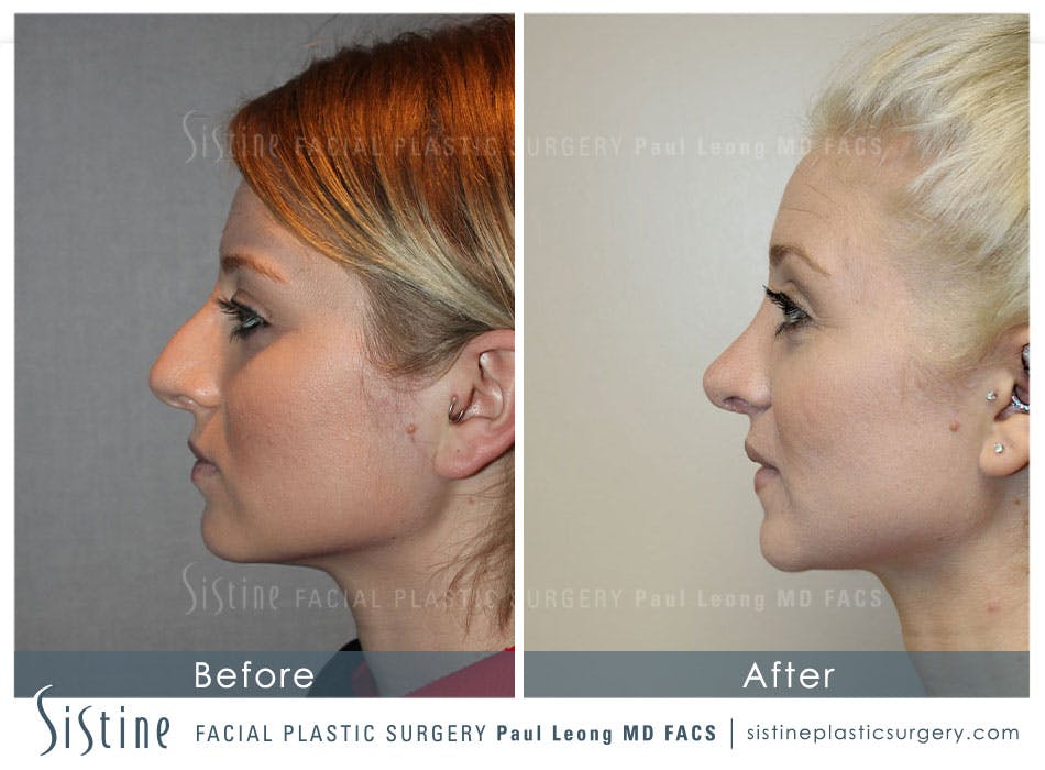 Restylane/ Juvederm Before & After Gallery - Patient 4891347 - Image 2