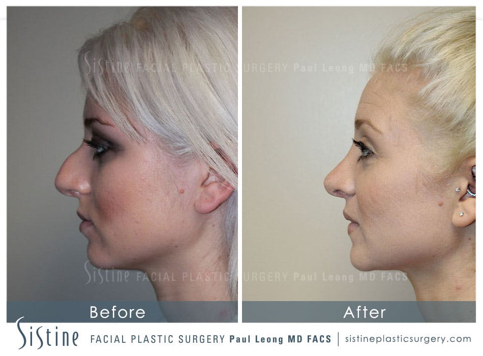 Restylane/ Juvederm Before & After Gallery - Patient 4891350 - Image 3