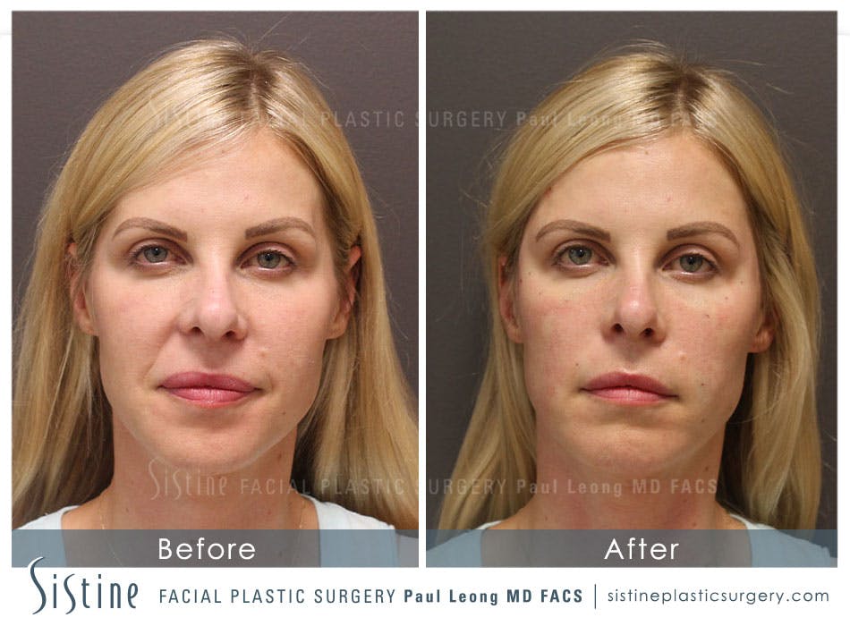 Restylane/ Juvederm Before & After Gallery - Patient 4891357 - Image 1