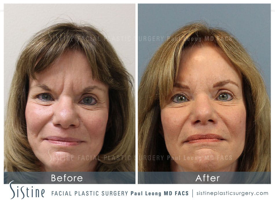 Restylane/ Juvederm Before & After Gallery - Patient 4891368 - Image 1