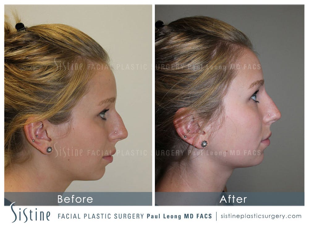 Restylane/ Juvederm Before & After Gallery - Patient 4891370 - Image 1