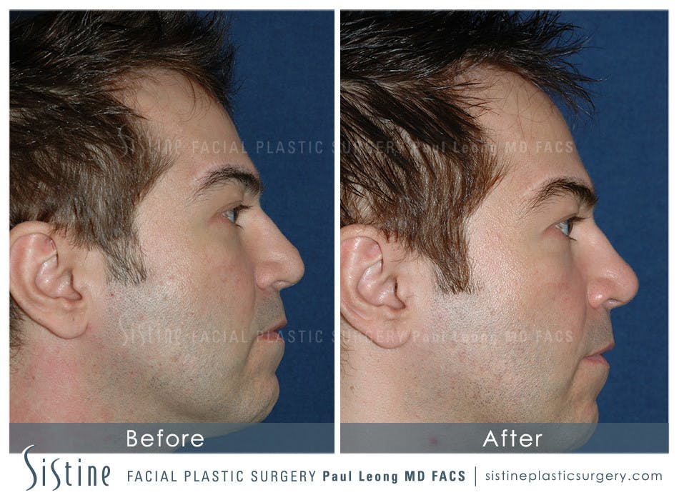 Restylane/ Juvederm Before & After Gallery - Patient 4891380 - Image 1