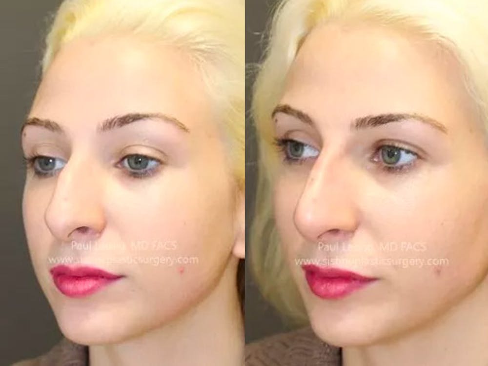 Restylane/ Juvederm Before & After Gallery - Patient 4891392 - Image 3