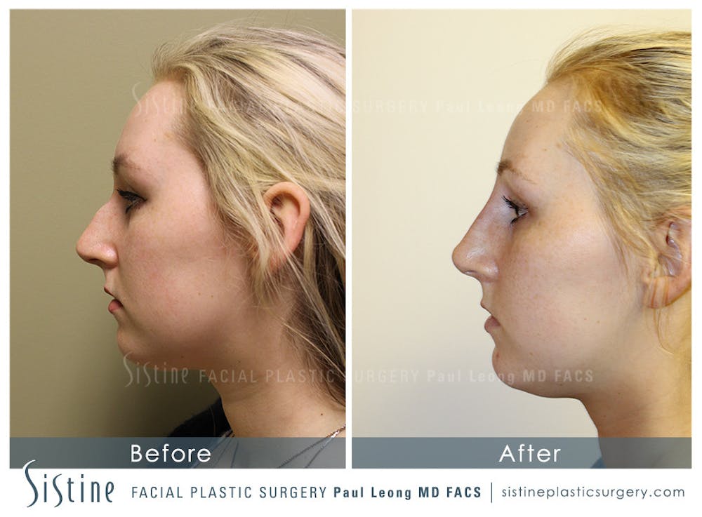 Restylane/ Juvederm Before & After Gallery - Patient 4891395 - Image 1