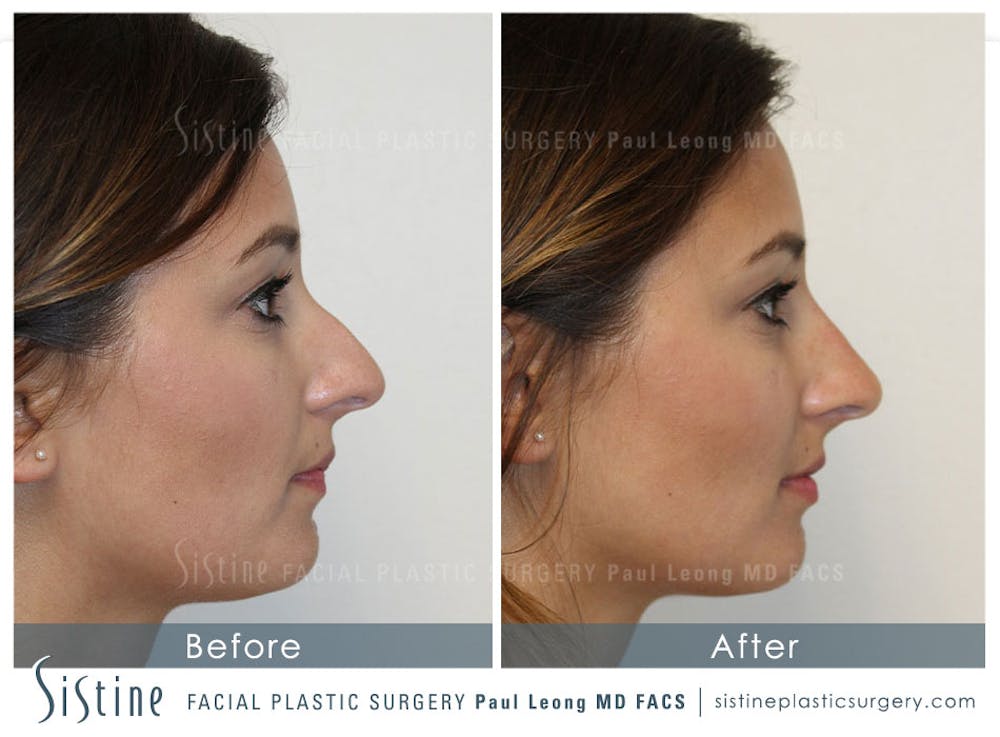 Restylane/ Juvederm Before & After Gallery - Patient 4891402 - Image 1
