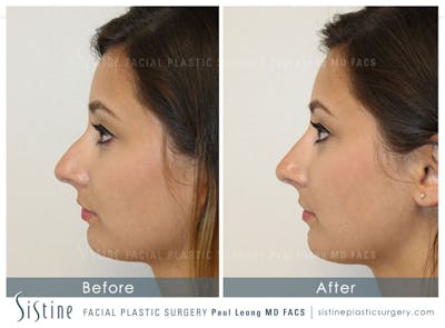Restylane/ Juvederm Before & After Gallery - Patient 4891402 - Image 2